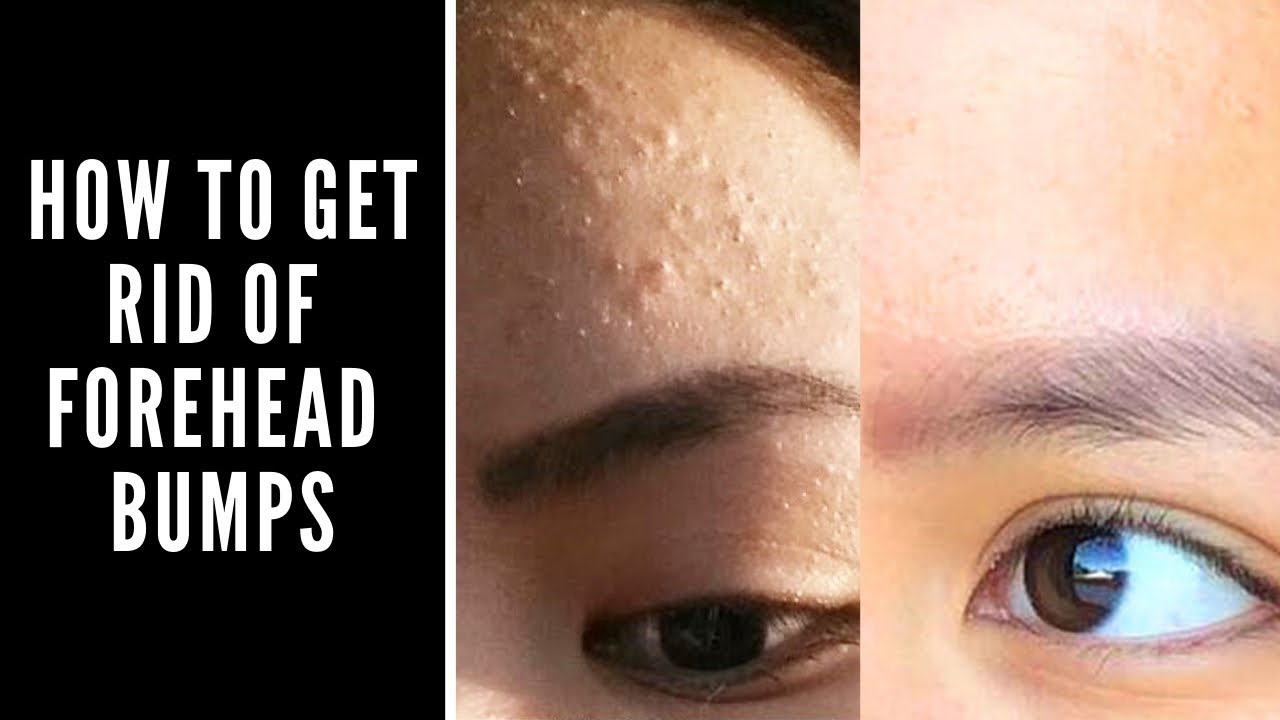 How To Get Rid Of Forehead Bumps Youtube