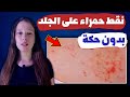 سبب ظهور نقط حمراء على الجلد بدون حكة 