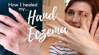 Hand Eczema Treatment Natural Cure - 7 Tips How I Healed My Hand ECZEMA | HEAL ECZEMA NATURALLY