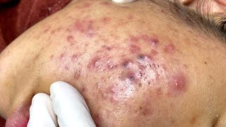 مريح جدا |كيفية ازالة الرؤوس السوداء relaxing removing black head