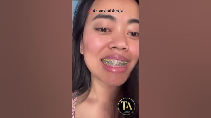 GUMMY SMILE BOTOX #dranshulthreja