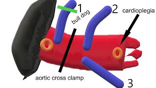 Complications of Exposing an Intramyocardial Left Anterior Descending Artery [LAD]: Part 2