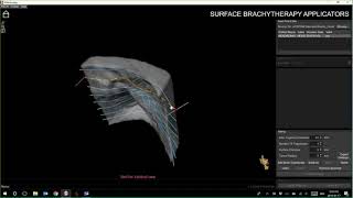 3D Bolus Webinar Series - Scalp and Nose Brachytherapy Applicator Demonstrations