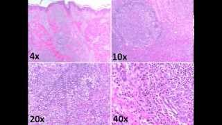 Dermatopathology quiz-Non-neoplastic lesions screenshot 2