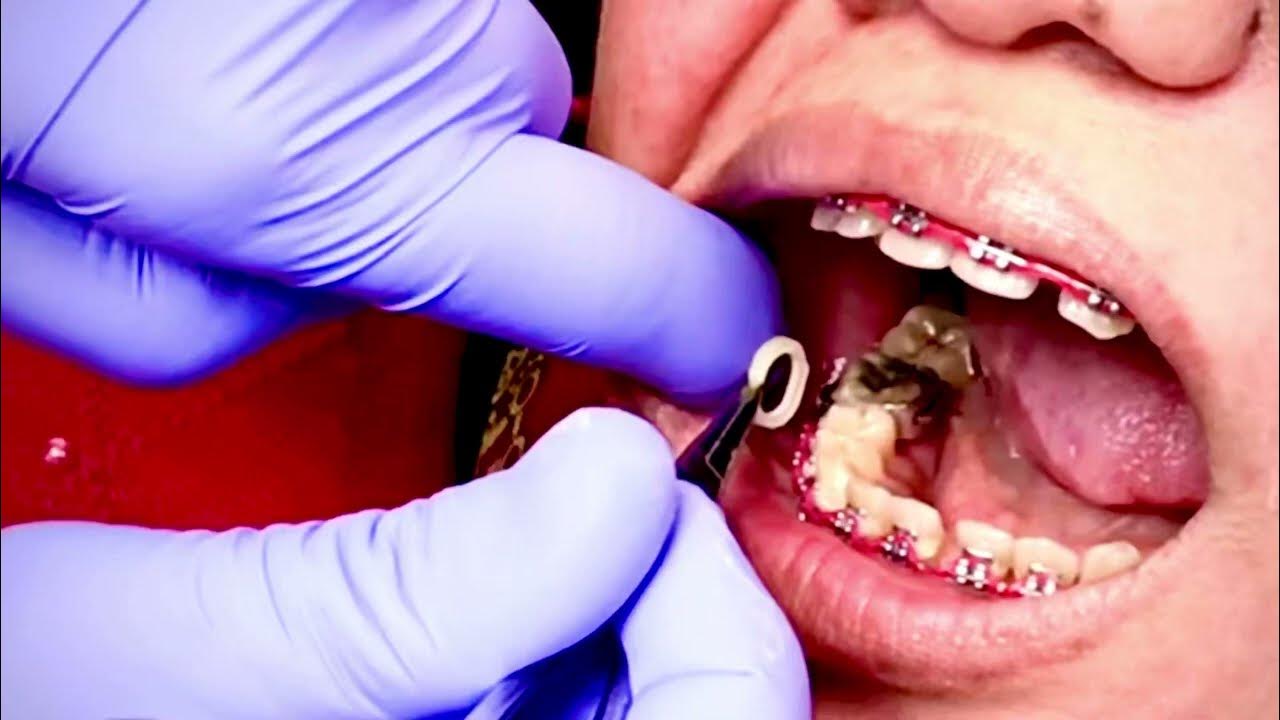 Getting rubber bands for the first time Braces Elastics 