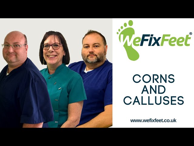 Common Foot Conditions - Corns and Calluses - by We Fix Feet, Nottingham and Derbyshire Foot Health