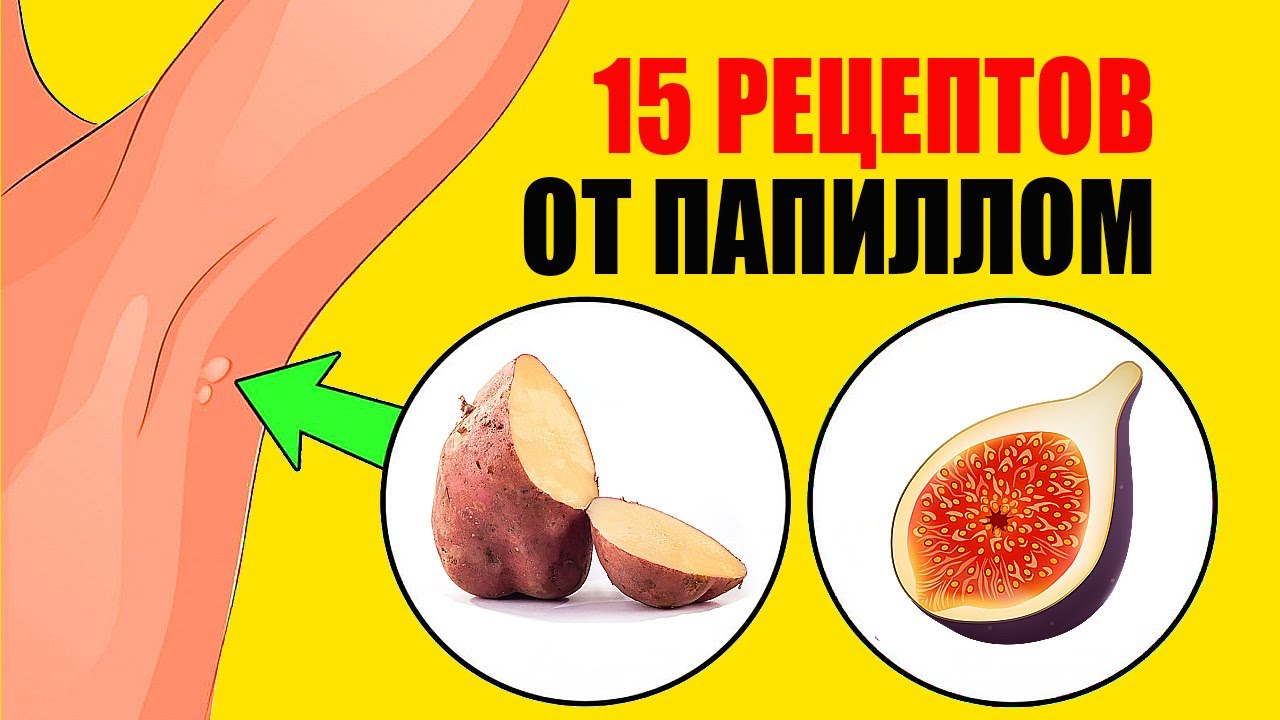 Проверенные Методы Как Избавиться От Папиллом - YouTube