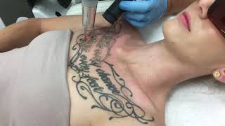 Tattoo Removal D Coast Australia