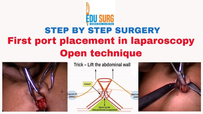 First port placement - Port placement in minimally invasive surgery -  Laparoscopic surgery steps 