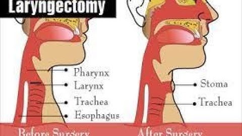 Pharyngolaryngectomy CPT code - simplify medical coding