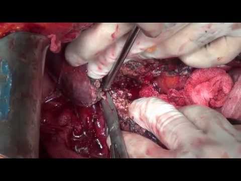 Video: Ex Vivo Resection Dan Shunt Portocaval Sementara Karsinoma Hepatoselular Yang Tidak Dapat Diikuti Diikuti Oleh Autotransplantasi Hati: Laporan Kes