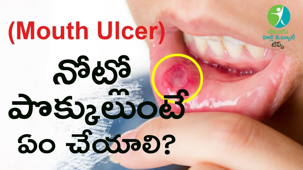 Mouth Ulcer Home Remedies Telugu mouth-ulcer-home-remedies-telugu
