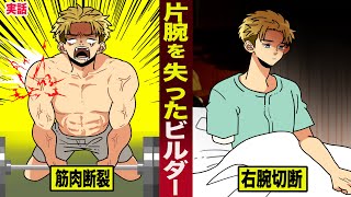 【実話】鍛えすぎて...片腕を失ったビルダー。筋肉断裂し...右腕切断。