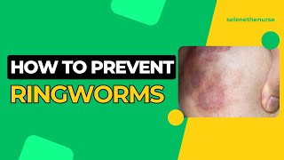 Ringworm - Types, Spread, Symptoms, Treatments And Prevention