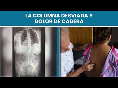 Columna desviada y dolor de cadera mejorada con la quiropráctica / Dr.  Craig, Manta Ecuador 