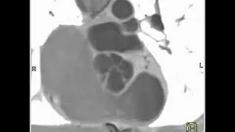 4D dislay of bicuspid aortic valve