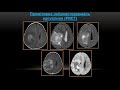 Achint singh imaging of pediatric brain tumors ukr