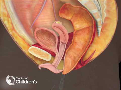 Surgical Treatment of Recto-Vestibular Fistula | Cincinnati Children's