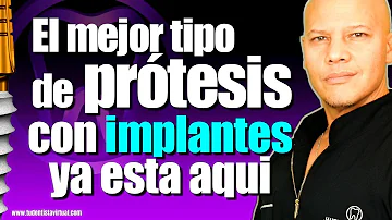 ¿Se pueden sustituir todos los dientes con implantes?