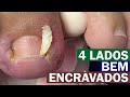 4 lados bem encravados! [Renata Werneck Podóloga Unha Encravada REMOVE INGROWN NAIL]