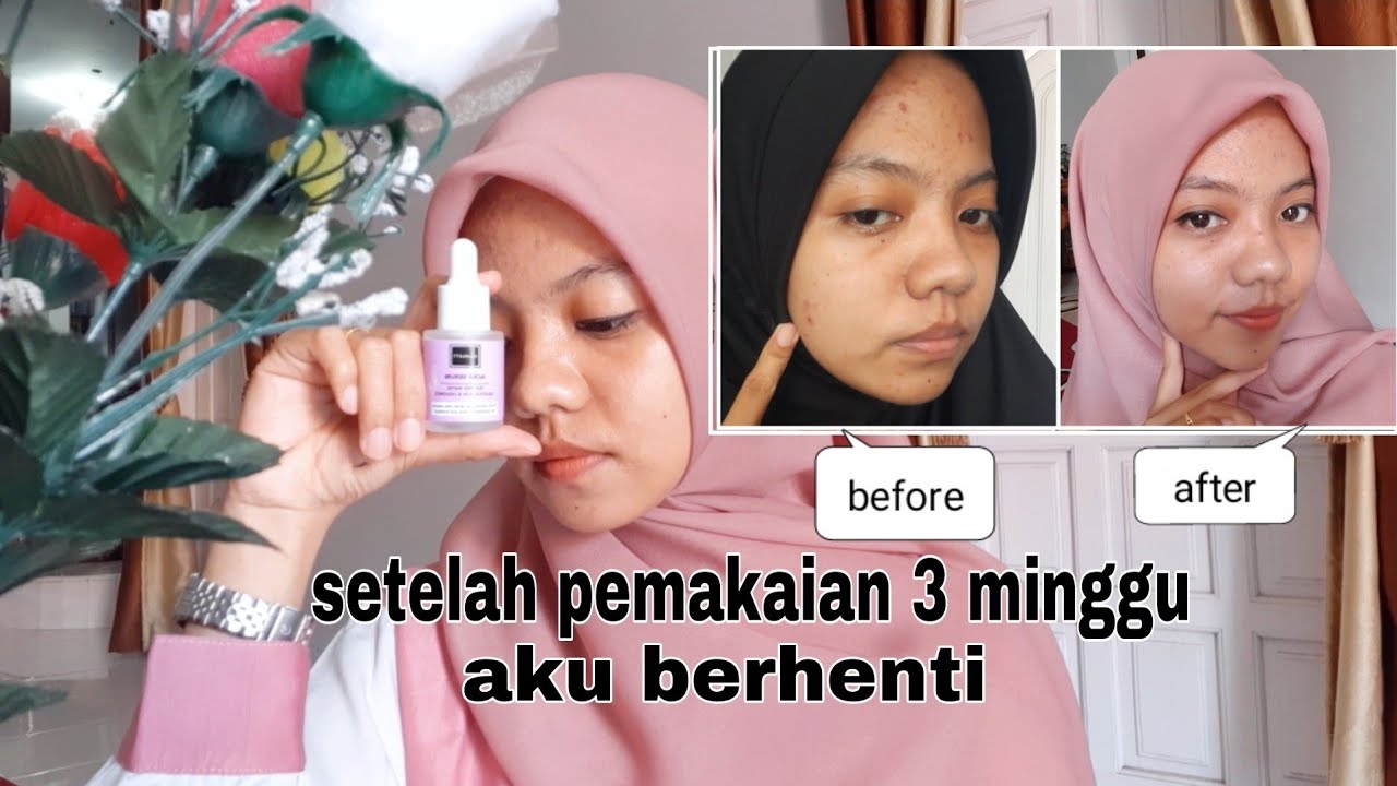 testi serum acne scarlett
