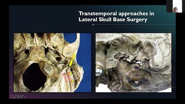 ACNS Symposium on Skull Series: "Lateral  Skull Base Basics" Sampath Chandra Prasad