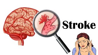 Stroke - Types, Causes, Risk Factors, Signs & Symptoms