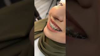 روعة تقويم الاسنان orthodontics retainer #dr_teeth_dento
