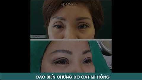[DR TALK] Các biến chứng do cắt mí hỏng | Viện thẩm mỹ Davinci