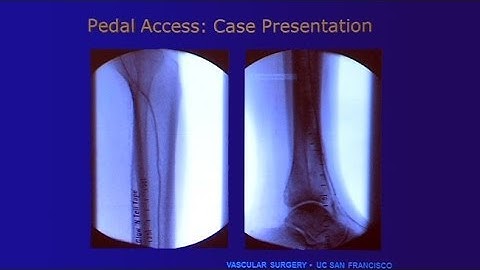 Pedal Access: When to Do it and How Does it Fare?