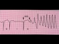 Torsades de pointes: tachycardie ventriculaire