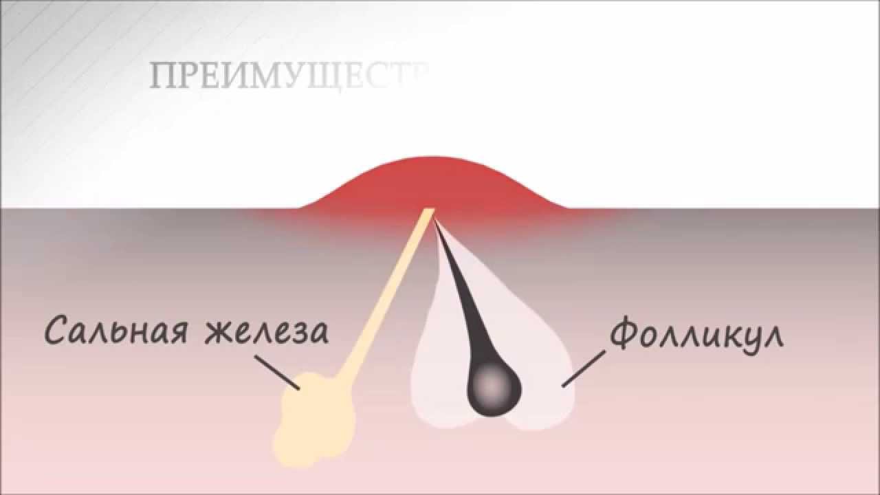 Преимущества шугаринг эпиляции перед восковой - YouTube