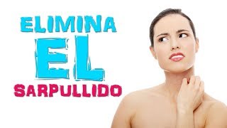 Como eliminar sarpullido rapidamente 9 REMEDIOS NATURALES