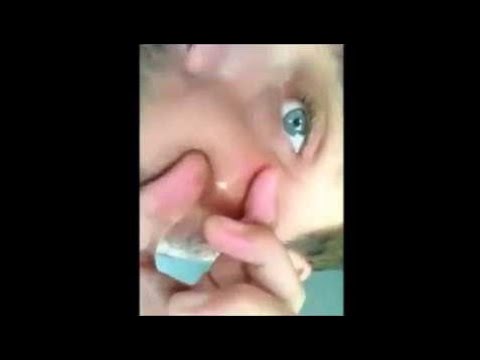 New Videos   Giant Blackhead Pimple Popped Cheek Squeezed!   -All pimples of the e | By Backhead 