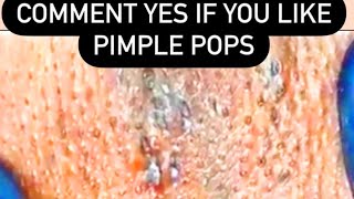 Are You A Popaholic?  Comedones, Blackheads, Whiteheads, Zits, Pimple Poppers and Dermatology