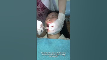 khoảnh khắc Tháo Niềng, khoảnh khắc mọi Đồng Niềng đều mong chờ khi Niềng Răng by Ngân Phượng