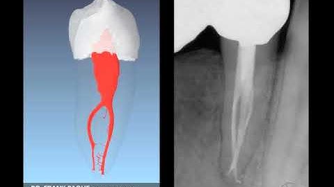 Shape Clean Pack: Rationale for Treatment - Mnd Teeth: Dr. Ruddle Advanced Endodontics
