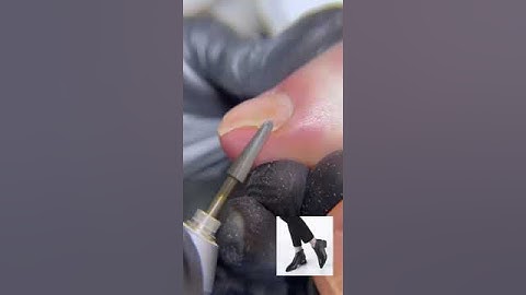 К чему приводит узкая обувь