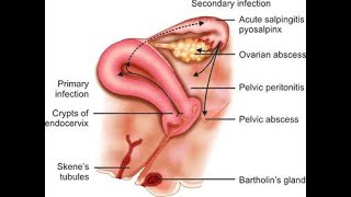 Parametritis Infection And Inflammation Of Parametriumconnective Tissue Surrounding Uterus