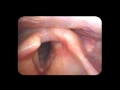 Vocal cord paralysis palsy 2  wwwdrjeevecom