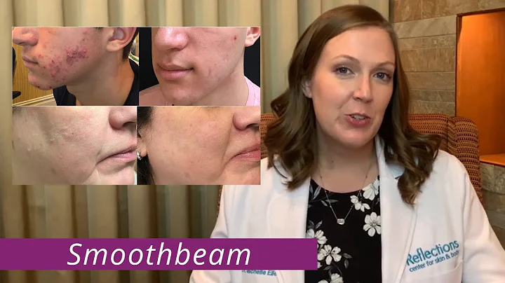 SmoothBeam Laser [ Acne Laser & Sebaceous Hyperplasia Laser ]