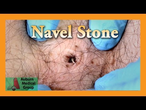 Video: Dirty Belly Button: Warum Und Wie Sie Ihren Nabel Reinigen