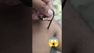 Di Gigit Lintah Itu Tidak Sakit!