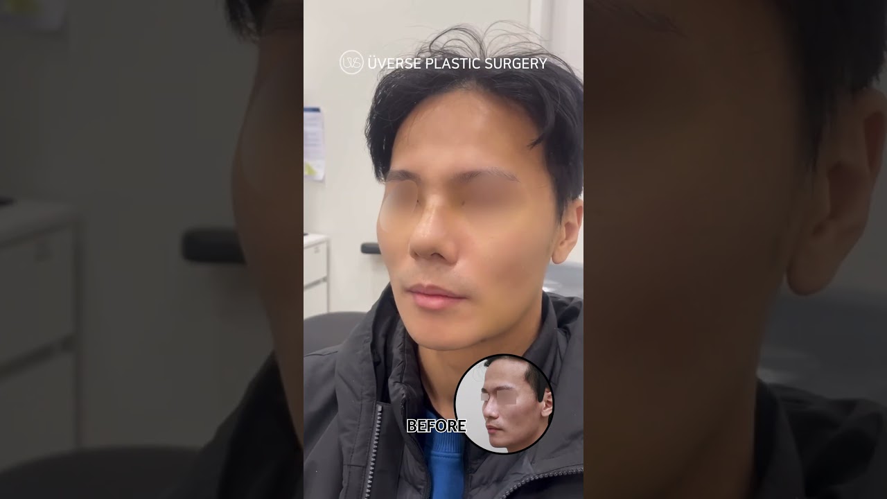 [Виверс гоо сайхны мэс заслын эмнэлэг] D+7 бугаг авсан, хамрын мэс засал. Виверс👃