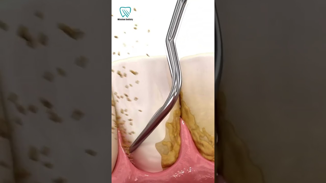 दांतों की सफाई 🦷🦷🦷 