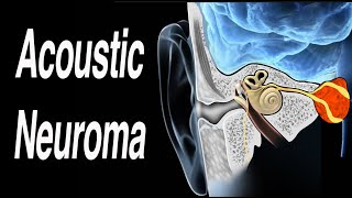 Acoustic Neuroma Causing One Sided Hearing Loss screenshot 2