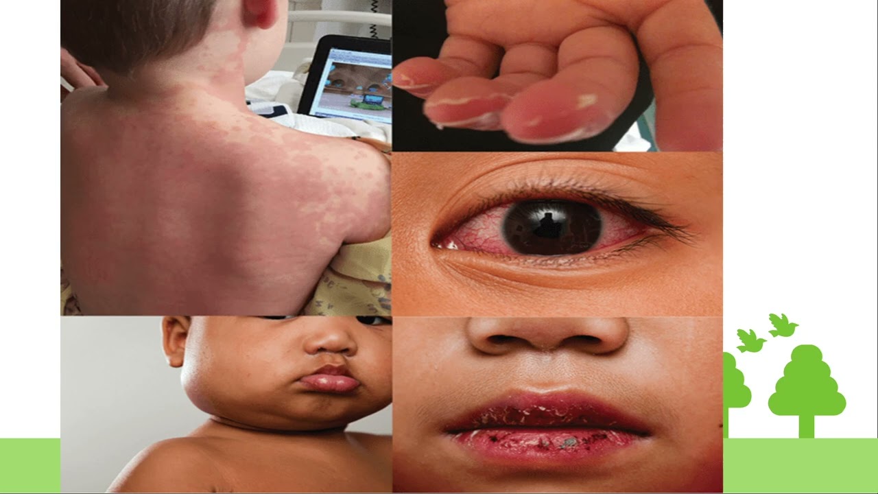 KAWASAKI DISEASE