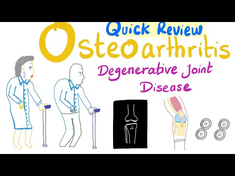 Osteoarthritis Quick Review