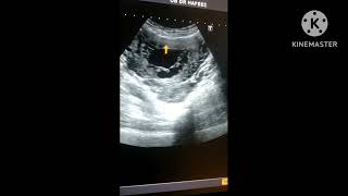 molar pregnancy ultrasound/treatment/angoori Hamal Kiya hota hai