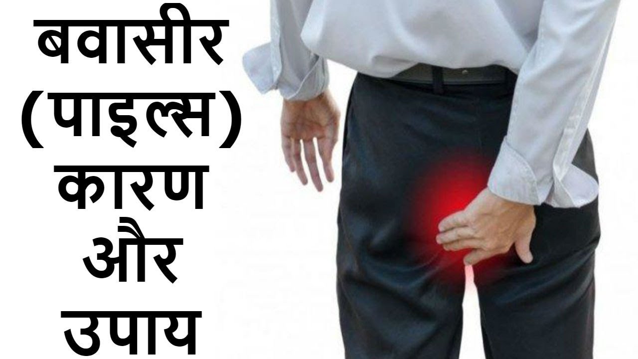 बवासीर (पाइल्स) कारण और उपाय Piles Treatment in Hindi YouTube